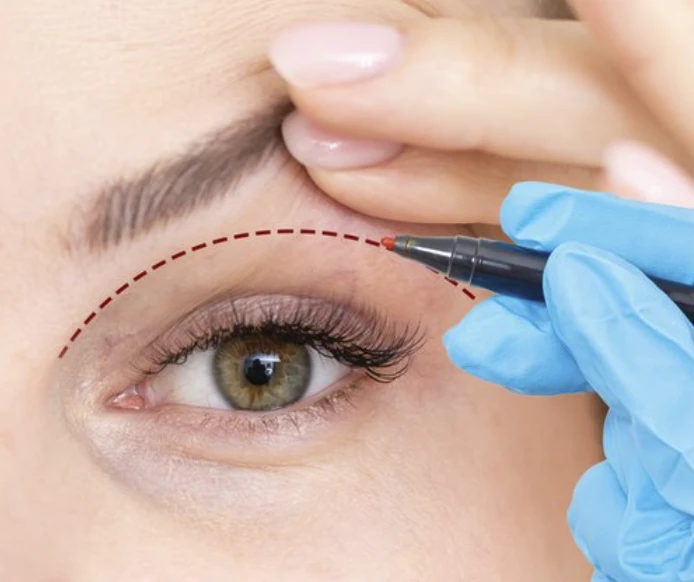 blefaroplastika